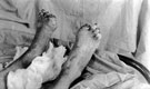 Frost bitten feet, Med. Exp. Force, 3rd Northern General Hospital, World War I